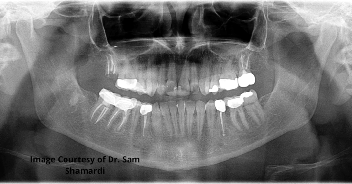 A frontal x-ray view of the patient's upper and lower teeth, post-procedure